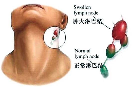 因甲醛超標而引起的淋巴癌怎么辦？