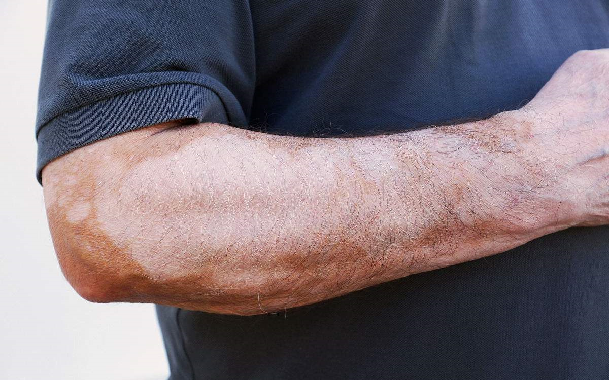 甲醛超標和白癜風有關(guān)系嗎？裝修污染對人體影響極大！