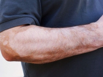 甲醛超標和白癜風有關(guān)系嗎？裝修污染對人體影響極大！